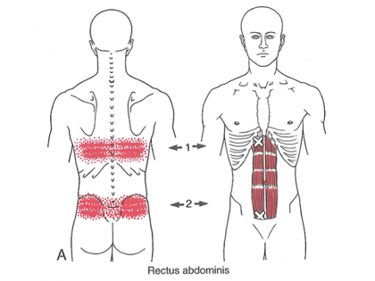 Trigger Point Referrals of the Rectus Abdominis