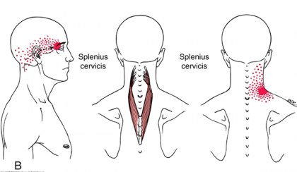 Splenius Cervicis Trigger Point Referral – Fiugre 15-2B<sup>3</sup>