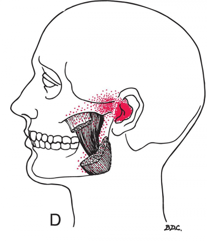 Masseter Deep Muscle Belly Trigger Point Referral – Figure 8-2<sup>3</sup>